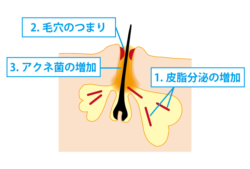 ニキビが出来る過程